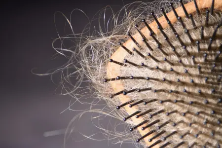 Seizoensgebonden haaruitval